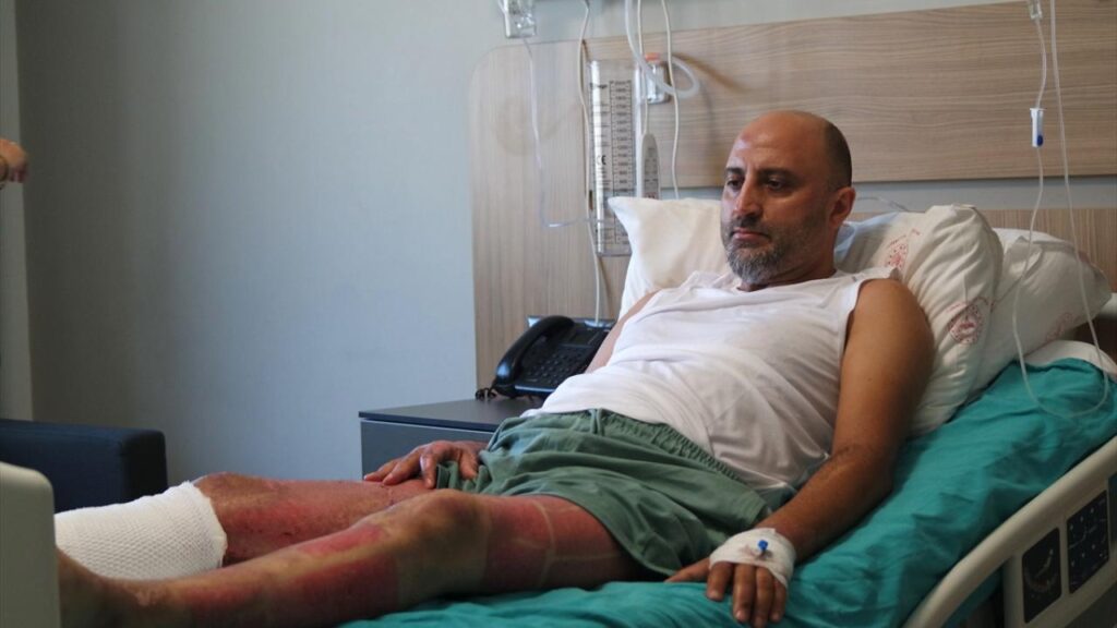 Mangal jeli nedeniyle vücudunun yüzde 38’i yanan hasta su dolu varile atlayarak kurtulmuş