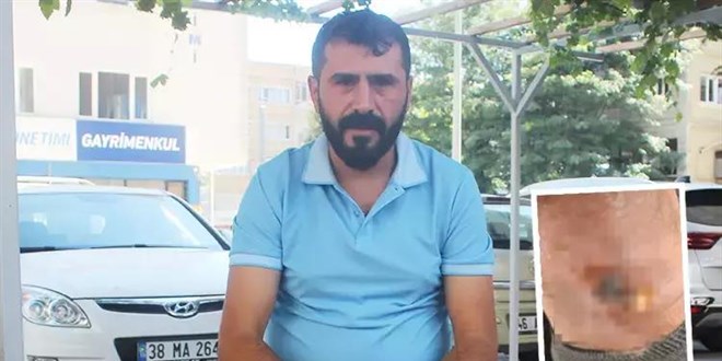 Yanlış sülük tedavisi hayatını kararttı! 2 aydır işe gidemiyor.