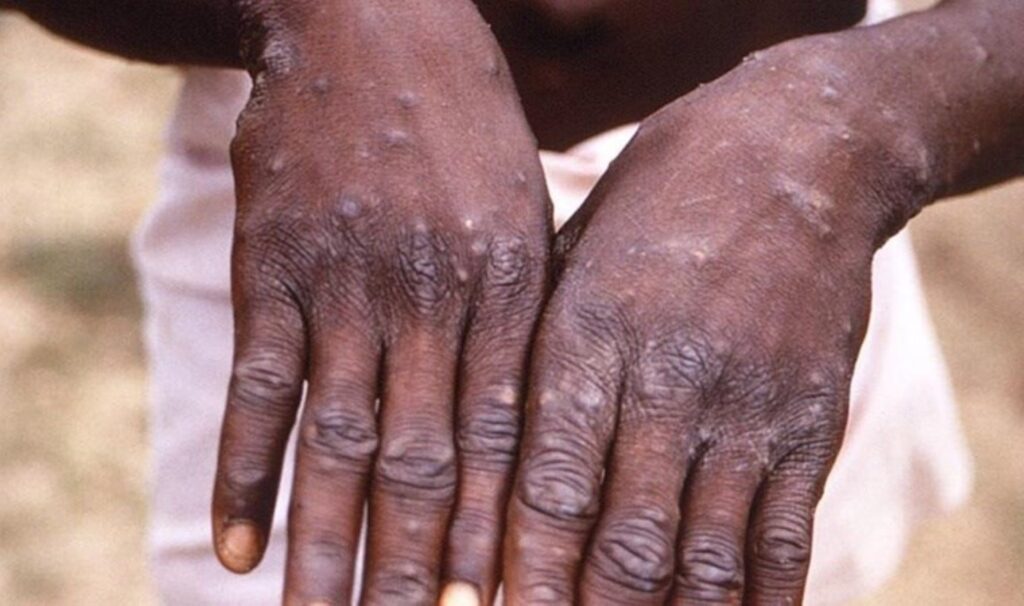 Afrika ülkesinde ‘M çiçeği’ alarmı: Vakalar rekor kırdı!