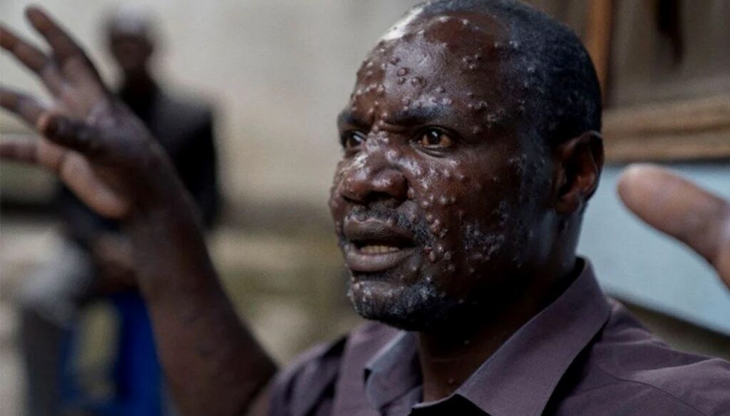 M çiçeği salgınında korkutan artış: Sierra Leone’de virüs patladı