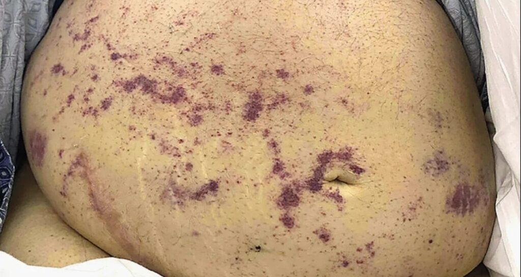 Böbrek nakli sonrası parazit şoku: İki hasta kurtçukla doldu