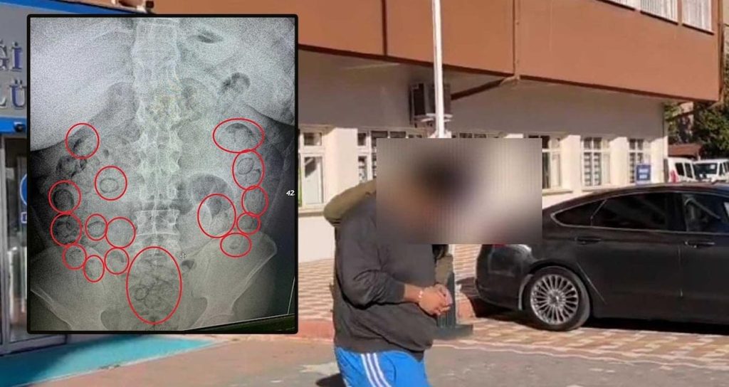 Skandal röntgende ortaya çıktı! 400 gram uyuşturucu bakın neresinden çıktı